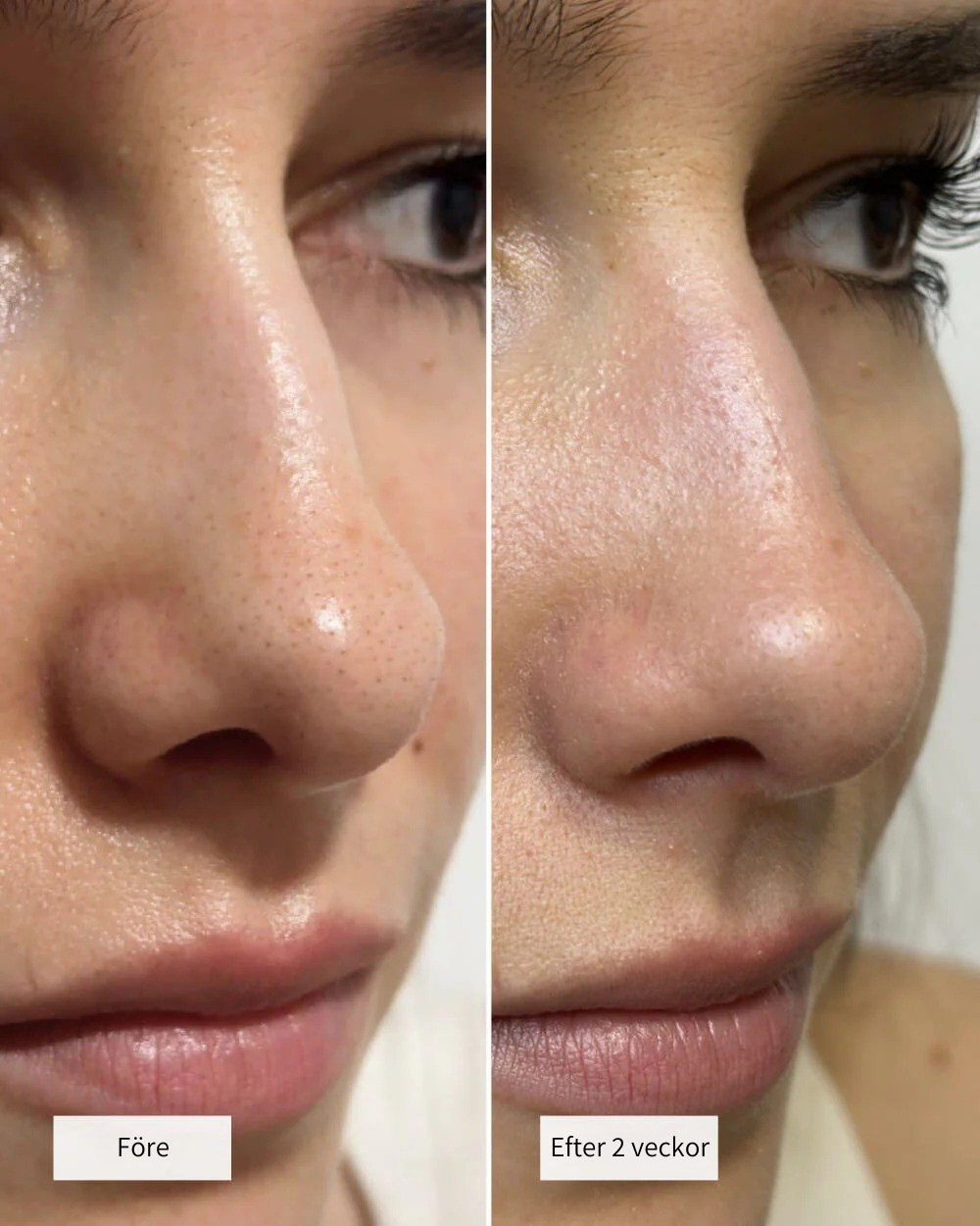 Veeya Hydrokolloid nose patches (8st per pack)